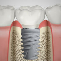 implantologia dentale bologna