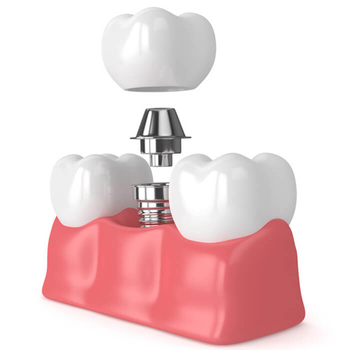 prezzo-impianto-denti-bologna