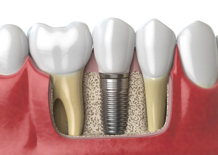 impiantologia dentale a bologna