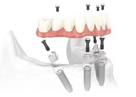 implantologia-dentale-bologna