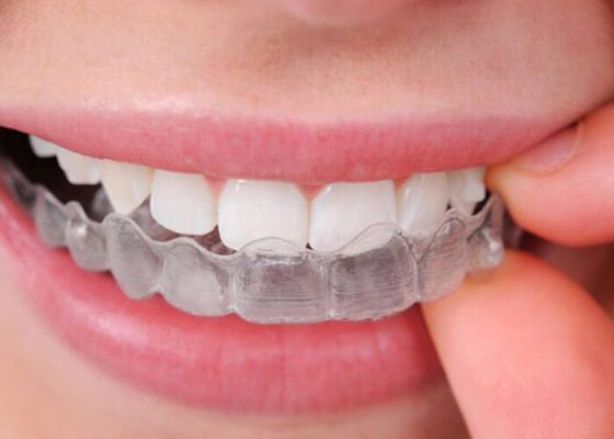 invisalign a bologna